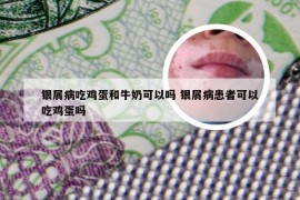 银屑病吃鸡蛋和牛奶可以吗 银屑病患者可以吃鸡蛋吗