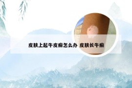 皮肤上起牛皮癣怎么办 皮肤长牛癣
