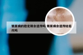 银屑病的稳定期会遗传吗 银屑病会遗传给后代吗