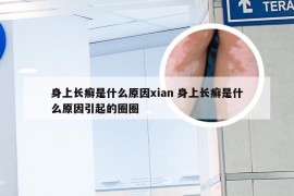 身上长癣是什么原因xian 身上长癣是什么原因引起的圈圈