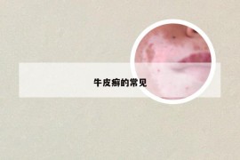 牛皮癣的常见