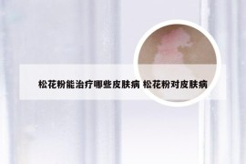 松花粉能治疗哪些皮肤病 松花粉对皮肤病