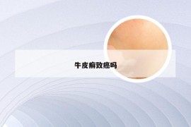牛皮癣致癌吗