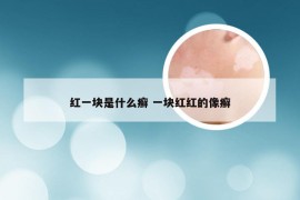 红一块是什么癣 一块红红的像癣