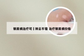 银屑病治疗可選祥云不错 治疗银屑病价格