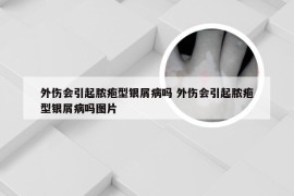 外伤会引起脓疱型银屑病吗 外伤会引起脓疱型银屑病吗图片
