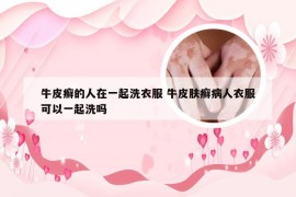 牛皮癣的人在一起洗衣服 牛皮肤癣病人衣服可以一起洗吗