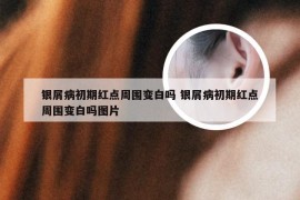 银屑病初期红点周围变白吗 银屑病初期红点周围变白吗图片