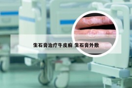 生石膏治疗牛皮癣 生石膏外敷