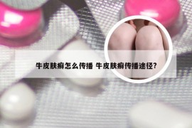 牛皮肤癣怎么传播 牛皮肤癣传播途径?