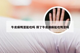 牛皮癣鸭蛋能吃吗 得了牛皮病癣能吃鸭蛋吗