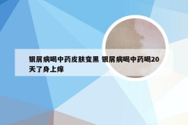 银屑病喝中药皮肤变黑 银屑病喝中药喝20天了身上痒