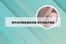 紫外线对银屑病的效果 紫外线治疗银屑