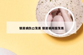 银屑病伤口发黑 银屑病周围发黑