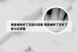 银屑病快好了又起红疙瘩 银屑病好了又长了些小红疙瘩