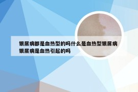 银屑病都是血热型的吗什么是血热型银屑病 银屑病是血热引起的吗