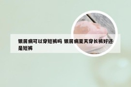 银屑病可以穿短裤吗 银屑病夏天穿长裤好还是短裤