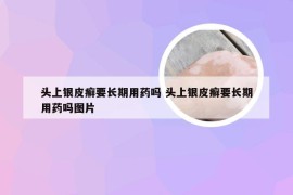 头上银皮癣要长期用药吗 头上银皮癣要长期用药吗图片