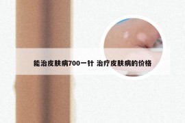 能治皮肤病700一针 治疗皮肤病的价格