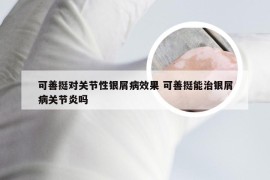 可善挺对关节性银屑病效果 可善挺能治银屑病关节炎吗