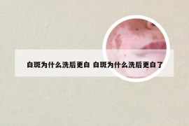 白斑为什么洗后更白 白斑为什么洗后更白了