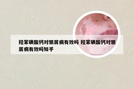 羟苯磺酸钙对银屑病有效吗 羟苯磺酸钙对银屑病有效吗知乎