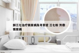 鲜三七治疗银屑病及寻常疣 三七粉 外敷 银屑病