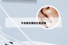 牛皮癣主要的位置在哪