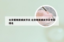 北京看银屑病关节炎 北京银屑病关节炎专家排名