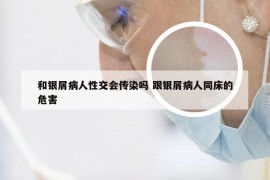 和银屑病人性交会传染吗 跟银屑病人同床的危害