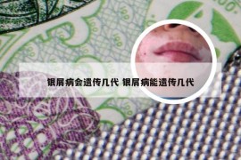 银屑病会遗传几代 银屑病能遗传几代