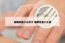 缠腰癣是什么样子 缠腰皮是什么病