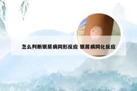 怎么判断银屑病同形反应 银屑病同化反应