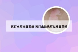 苏打水可治真军癣 苏打水洗头可以除真菌吗