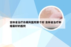 吉林省治疗白癜风医院那个好 吉林省治疗肿瘤最好的医院