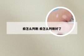 癣怎么判断 癣怎么判断好了