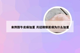 来例假牛皮癣加重 月经期银屑病为什么加重