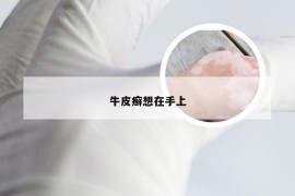 牛皮癣想在手上
