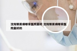 沈阳银屑病哪家医院最好 沈阳银屑病哪家医院最好的