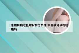 患银屑病吃牡蛎粉会怎么样 银屑病可以吃牡蛎吗