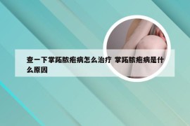 查一下掌跖脓疱病怎么治疗 掌跖脓疱病是什么原因