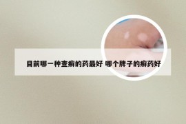 目前哪一种查癣的药最好 哪个牌子的癣药好