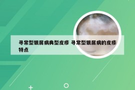 寻常型银屑病典型皮疹 寻常型银屑病的皮疹特点