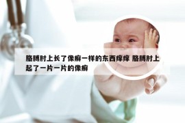 胳膊肘上长了像癣一样的东西痒痒 胳膊肘上起了一片一片的像癣