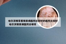 哈尔滨哪家看银屑病医院比较好的医院比较好 哈尔滨银屑病医院去哪家