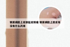 银屑病脸上皮肤起皮刺痛 银屑病脸上脱皮有没有什么药用