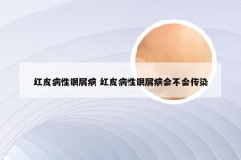 红皮病性银屑病 红皮病性银屑病会不会传染