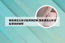 银屑病怎么样才能得到控制 银屑病怎么样才能得到控制呢
