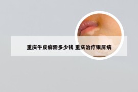 重庆牛皮癣需多少钱 重庆治疗银屑病
