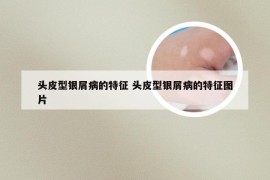 头皮型银屑病的特征 头皮型银屑病的特征图片